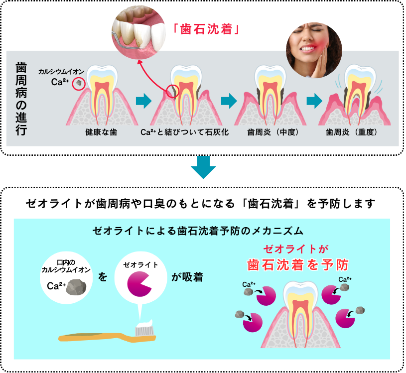 歯石沈降